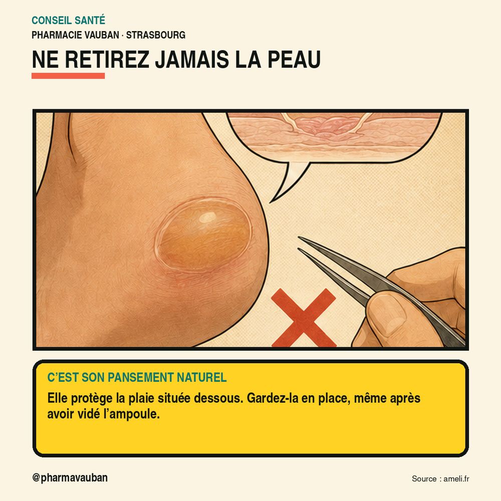 Ne jamais retirer la peau qui recouvre une ampoule : c'est le pansement naturel de la plaie, même après l'avoir vidée